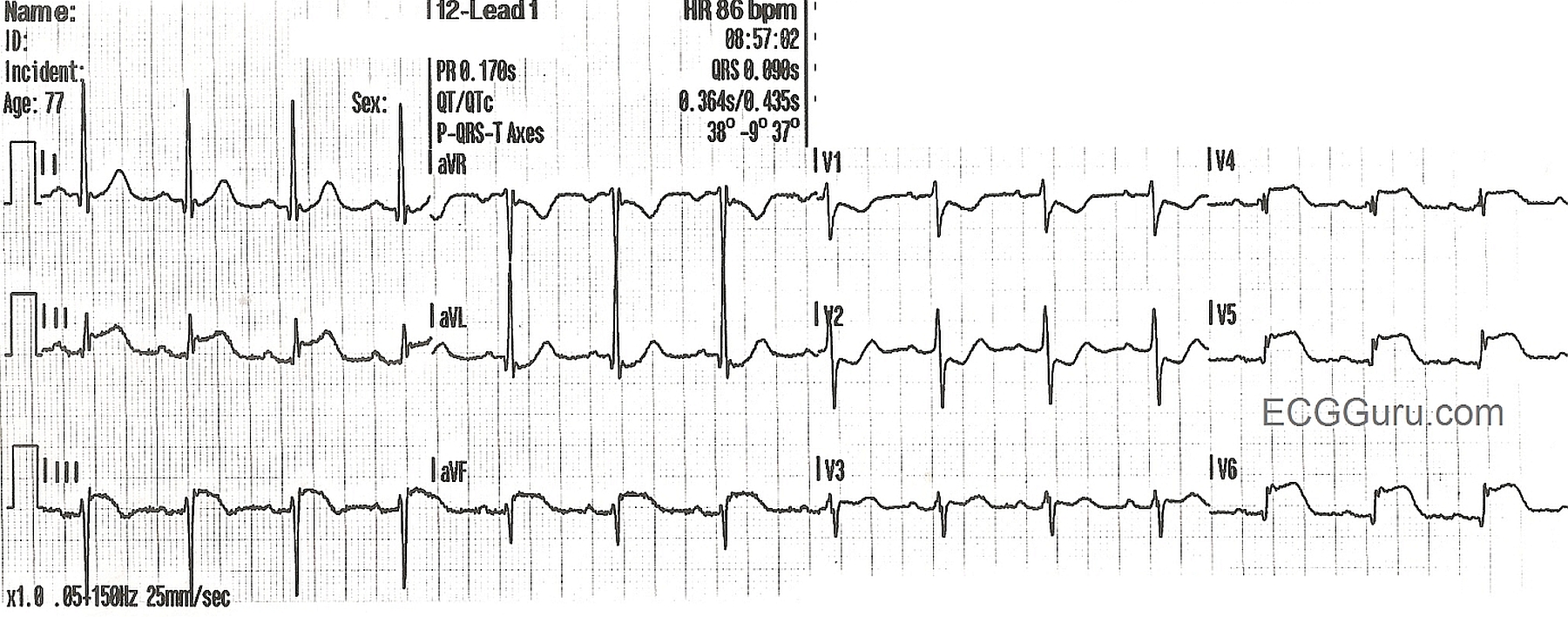 ekg strip of an acute mi Puffy amiyumi teen titans japanese